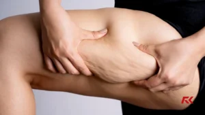 3 dicas para acabar com a celulite